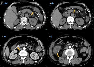 Frontiers Intestinal Obstruction Due To Idiopathic Mesenteric